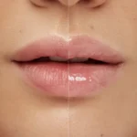 lip volume – Image 2